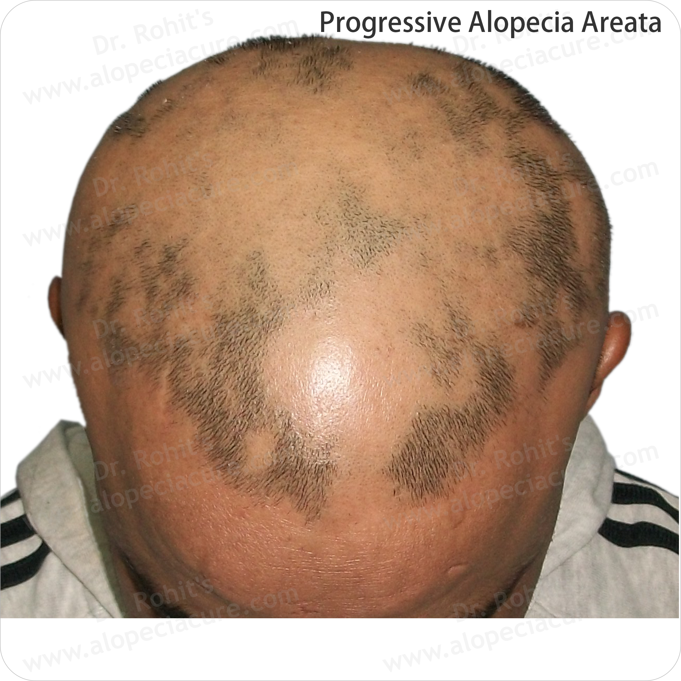 Clinical Hair Treatment
